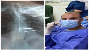 استخراج ملعقة من بطن مسنة في 7 دقائق ينقذ حياتها في مستشفى شبين الكوم